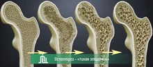 Остеопороз