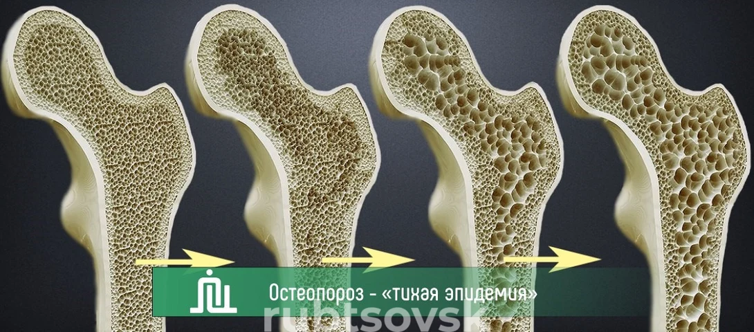 Остеопороз